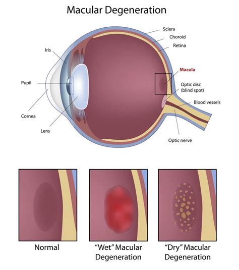 macular degeneration how long till blind.